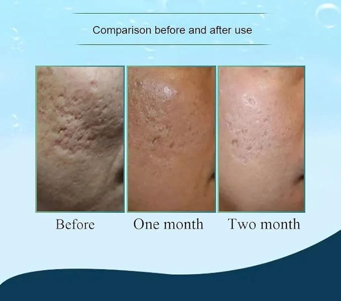 Hydra Needle 20 Titanium Serum Applicator Tools Reusable