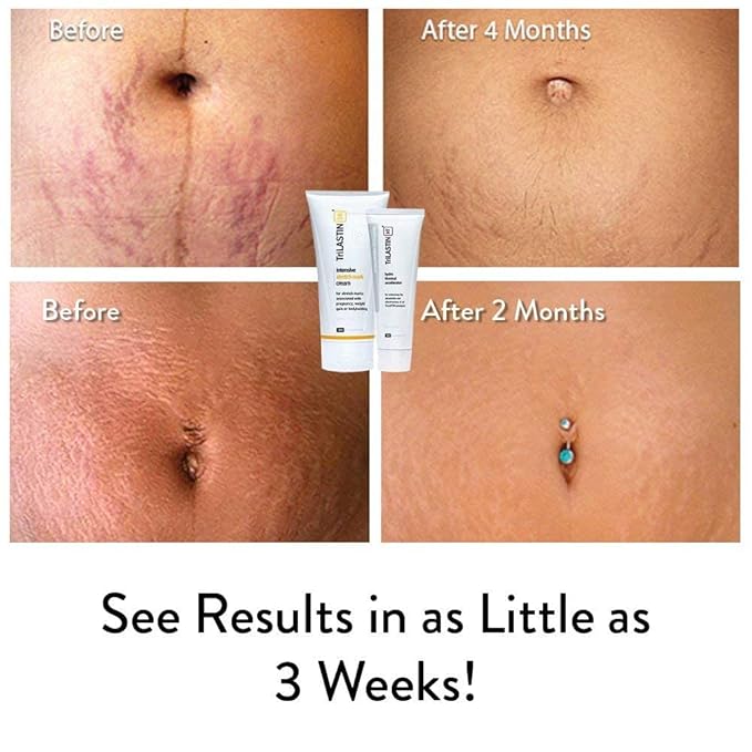 TriLASTIN-SR Intensive Stretch Mark Cream Bundle with Hydro-Thermal Accelerator (5.5 & 3 oz) | Fast-Acting Stretch Marks Cream with Absorption Enhancing Serum | Hypoallergenic & Paraben-free