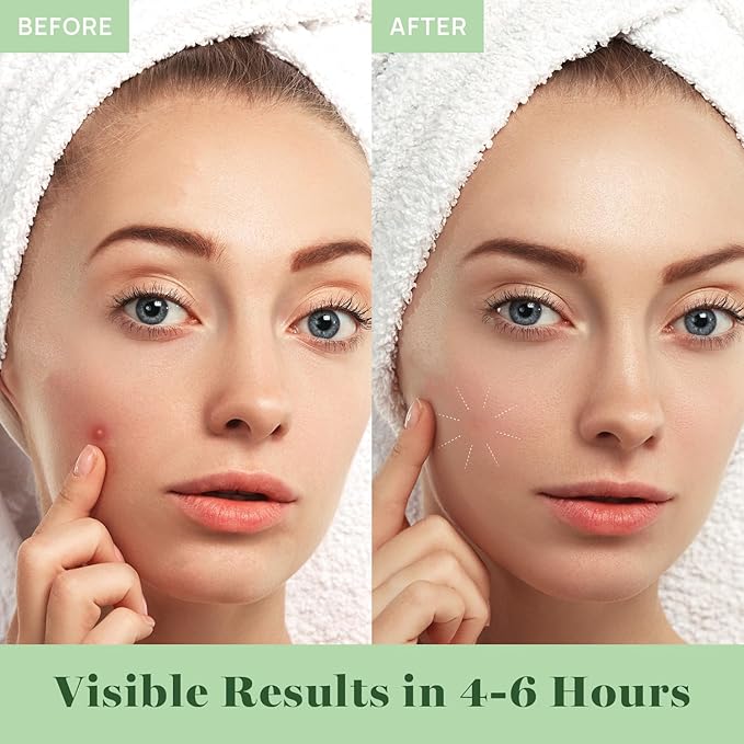 AOA Studio Absorbing Cover Healing Invisible Acne Patch Blemish Spot, Treatment, Facial Acne Patch Vegan, Cruelty Free, Hydrocolloid, Two Sizes 10mm 12mm (Total 84 Counts)