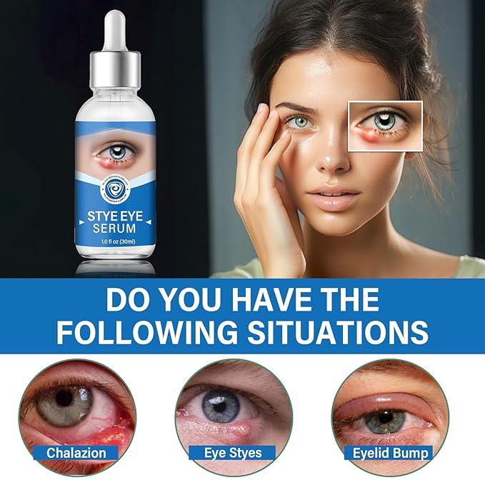Stye Eye Treatment, Stye Eye Serum for Styes Chalazion and Blepharitis, Gently Cleanses Lashes and Eyes, Restore Healthier Eye Skin, 1 Fl.oz