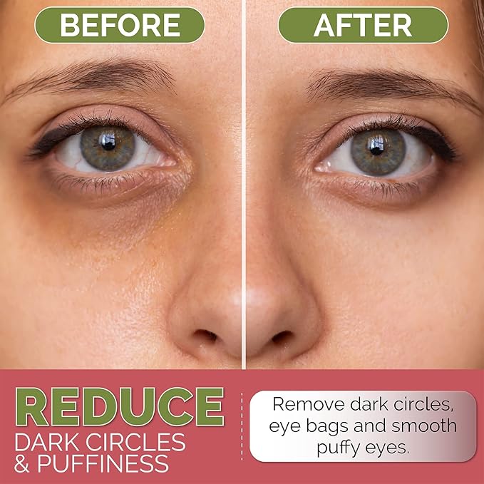 Under Eye Mask for Dark Circles, Puffiness and Eye Bags with Rose (60 Patches), Anti-Wrinkle for Puffy Eyes, Eye Masks with Hyaluronic Acid and Collagen Hydrogel Eye Gel Pads, Premium Korean Skincare